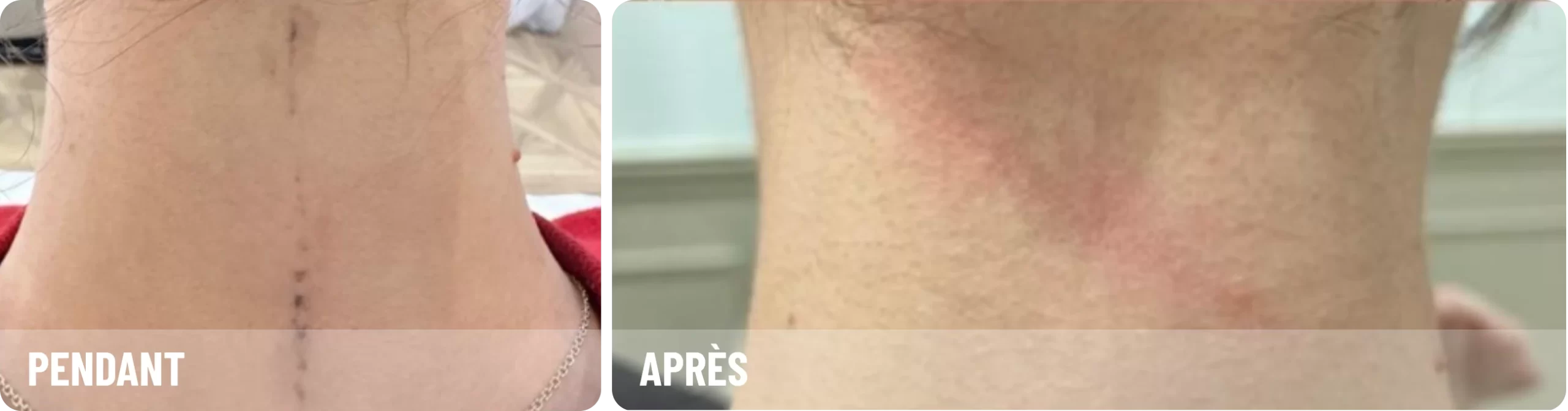 Après